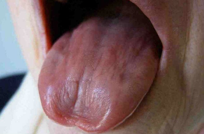 El sindrome de Sjogren afecta al 3 por ciento de la poblacion