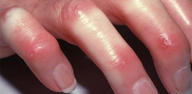 Esclerodermia tipos