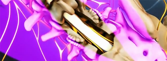Estenosis canal lumbar laminectomia