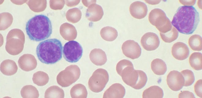 Terapia genética para la leucemia