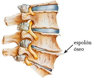 Radiculopatía cervical espolón óseo