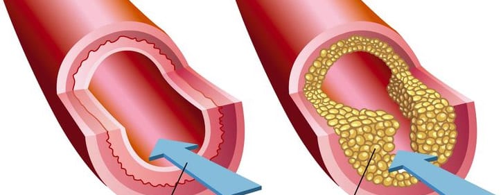 Ulceras isquémicas. Ateroesclerosis. Venas obstruidas